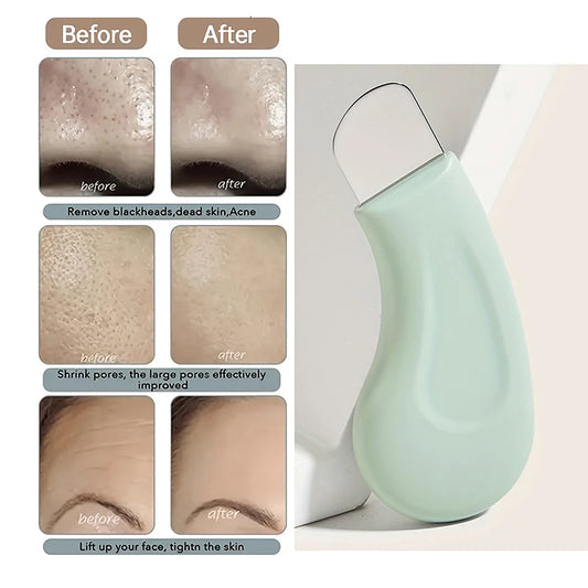 Blackhead Remover Tool | Nose & Facial Pore Cleaner